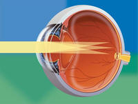 astigmatism