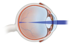 myopia