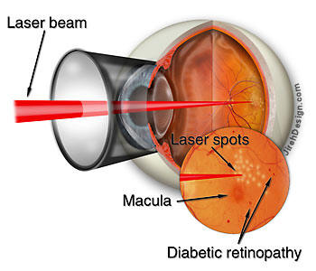 retinallaser diabteic
